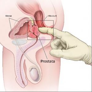 How To Use A Prostate Stimulator